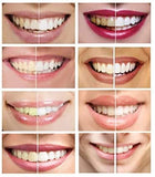 White Teeth GLobal Teeth Whitening Gel 44% Carbamide Peroxide, 6 Tooth Bleaching Gel Syringes