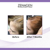 Zenagen Revolve Thickening Hair Loss Treatment for Women, 6.75 Fl. Oz.