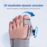 Treatmedy Bunion Fix, Adjustable Bunion Corrector, Bunion Corrector for Toe Repair, Big Toe Straightener Splint for Women and Men, Hammer Toe Fix and Bunions Correction (Gray)