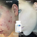 Clearstem(age+acne) Mind.body.skin Vitamin ( 2-PACK ) 180 capsules total