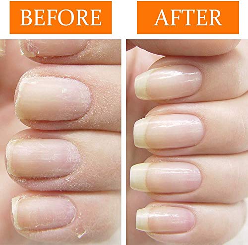 Nail Tek Repairs Damaged Nails kit.Intensive Therapy(.5OZ),Foundation(.5OZ)& Renew(.48OZ)