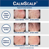 CalmScalp Topical Solution for Symptoms of Mild to Moderate Psoriasis | Irritated Scalp | Hairline Scales | Redness | Dry Scalp | Made in The USA | 4 oz.