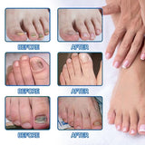 Toenail Fûngus Treatment, 32 Pcs Nail Repair Patches, Nail Repair Treatment for Damaged Nails and Appearance of Discolored