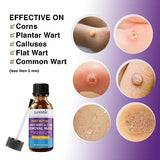 Wart Corn Removal for Feet: Salicylic Acid Plantar Wart Corn Remover Treatment for Toes Foot Fingers Hands