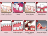 Automix Permanent Dental Cement for Caps, Crown, Bridges, Inlays, Onlays, Implants, Veneers