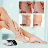 GROCERISMVaricose Veins Treatment for Legs - Healing Natural Oils Formula, Anti Varicose Vein Soothing Leg Cream, Varicose Veins Treatment for Legs（1.76 fl oz ）