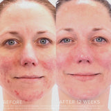 Rodan and Fields Umblemish Regimen for Acne and Post-Acne Marks