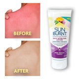 Sunburnt Advanced After-Sun Lotion, 6 Ounce