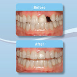 OrVance Aligner Pontics | Temporary Tooth Replacement for Aligner Trays and Retainers during Orthodontic Treatment (Value Size)