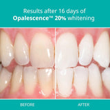 Opalescence 20% Gel Syringes Teeth Whitening - Refill Kit (6 Packs / 12 Syringes) Carbamide Peroxide. Made by Ultradent, in Mint Flavor. Tooth Whitening - B-5196-6