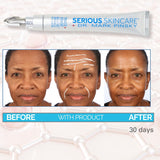 Serious Skincare - Dr. Mark Pinsky - Trace + Erase Needle Free Wrinkle Filler - Fills Visible Deep Lines, Wrinkles and Creases - Helps Restore Skin's Elasticity and Tone - Face and Neck 1 Fl Oz