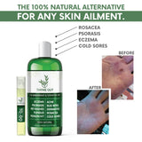 All Natural Eczema Treatment- Psoriasis Treatment - an All-in-One Solution for Acne, Dermatitis, Rosacea, Cold Sores, Pet Rashes, Bug Bites, and Poison Ivy - Anti-Itch Spray for Itchy Skin Relief