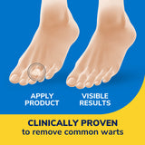 Dr. Scholl's Clear Away WART Remover HYDROGEL Bandage // 12 Discs/9 Cushions, Clinically Proven, Immediate & All-Day Cushioning Pain Relief, Multi-Day Coverage, 12 Treatments