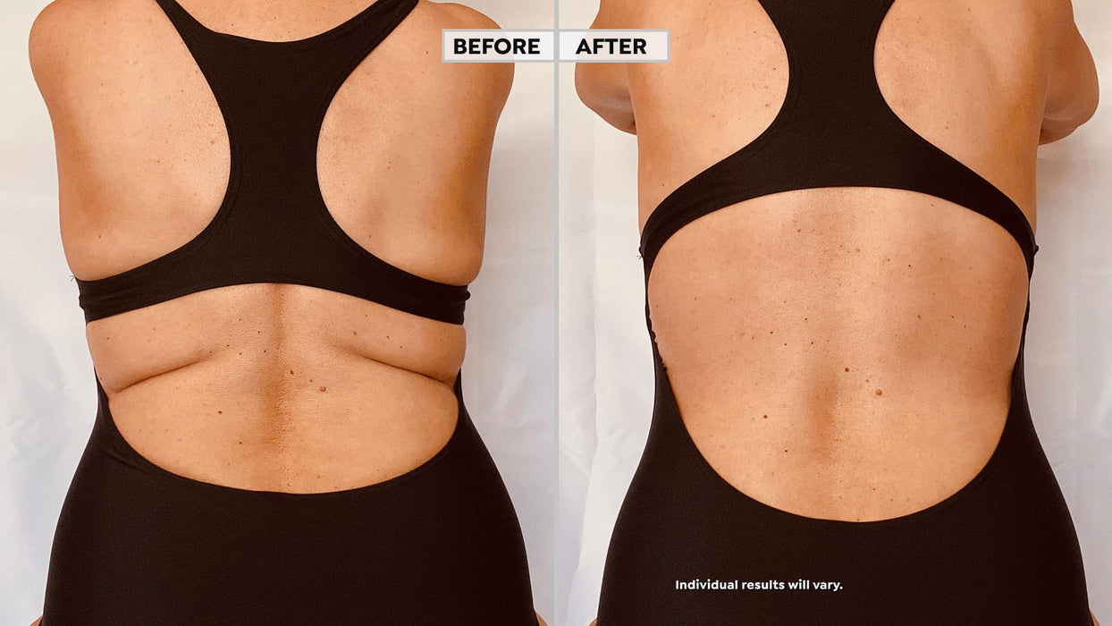 Skinnies Instant Lifts - 5 Pair Back Lifts - PATENTED MADE USA FLATTENS BACK FAT INSTANTLY Clear Adhesive Strips Instantly Smooth Back Fat. Go Backless!