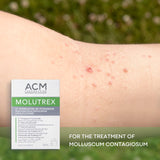 Molutrex Molluscum Contagiosum Treatment, 3ml