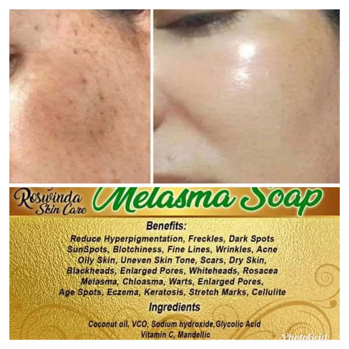 Melasma Soap Whitening Dark Spot Hyperpigmentation Freckles More 100% Effective