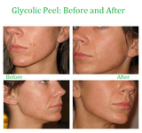 Glycolic Acid Face Peel Kit Medical Grade Pure Acne Scars Wrinkles Anti-Aging - Strength 10%, 1 oz