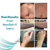 NewGel+E Advanced Silicone Scar Treatment Gel for OLD and NEW Scars w Vitamin E, for Surgery, Injury, Keloids, Burns, and Facial Blemish Scars (15 Grams)