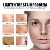 Acclyd Face Whitening Cream Dark Spot Remover for Face, Skin Lightening Cream, Hyperpigmentation Treatment Quick Effect, Freckles Melasma Brown Spot Corrector for Men Women (0.8 FL.OZ)