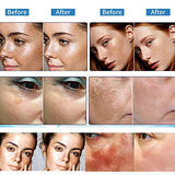 Paradise Emerald Dark Spot Remover for Face, Hyperpigmentation Treatment, Melasma, Freckle, Sun Spots Removal for All Skin Types Dark Spot Corrector for Men and Women