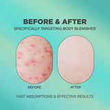 Butt Acne Cream | Butt Acne Cream for Ingrown Hairs, Bikini Bumps, Razor Bumps and other Body Blemishes | Butt Acne Cream for Body Blemishes | Butt Acne Cream Formulated with Natural and Innovative Formula | Butt Acne Clearing Lotion for Fast and Effectiv
