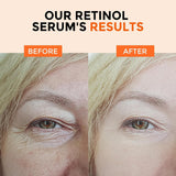 +1Herolabs Face Serum Set – Retinol Serum & Hyaluronic Acid Serum for Face – Anti Aging Serum Skin Care Set for Women – Serum for Firm, Wrinkle Smoothing