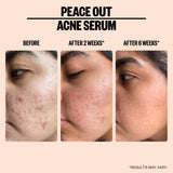 Peace Out Skincare Acne Serum. Daily Multi-Benefit Face Serum with 2% Salicylic Acid to Target Pimples, Zits, Blemishes and Breakouts, For Clearer-Looking Skin (1 fl oz)
