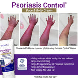 TriDerma Psoriasis Control Face & Body Cream - Maximum Strength 3% Salicylic Acid, AP4 Aloe Vera Gel, Urea Cream - Extra Moisturizing Treatment, No Cortisone or Coal Tar - FSA Eligible - 6 Oz